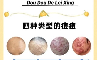 男朋友很会玩我的痘痘(爱痘如痘”，男友的手术刀)