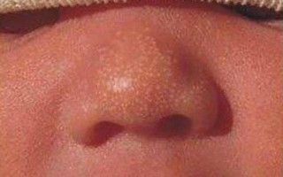 小宝宝嘴巴下面长湿疹怎么办(宝宝尿裤子嘴硬疼，究竟为何？揭秘背后的真相)