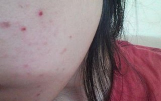 男朋友突然会按我的小痘痘了_男友突袭痘痘王国，意外引爆惊喜